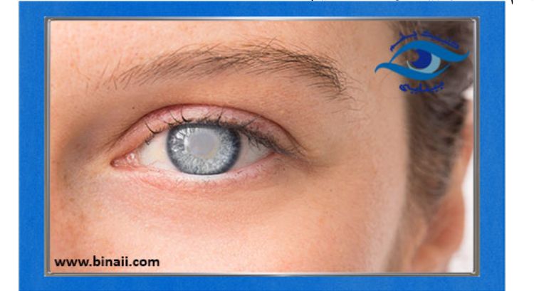 آب مروارید، آشنایی با روش های عمل جراحی 

