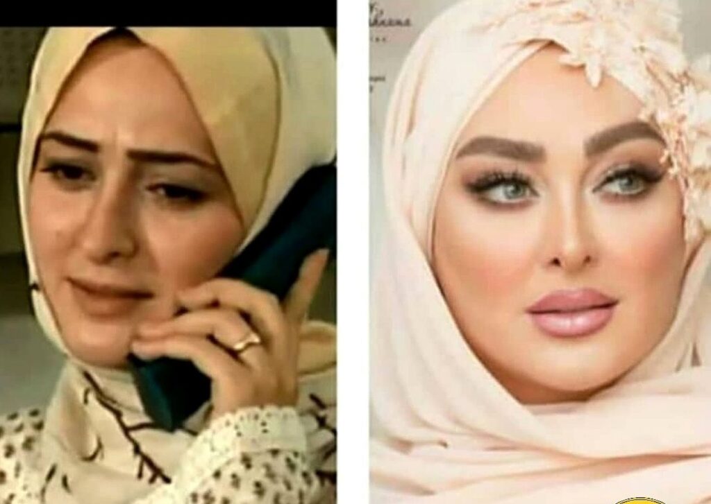 اولین فیلم از عمل زیبایی الهام حمیدی | تغییر 180 درجه ایی الهام حمیدی 