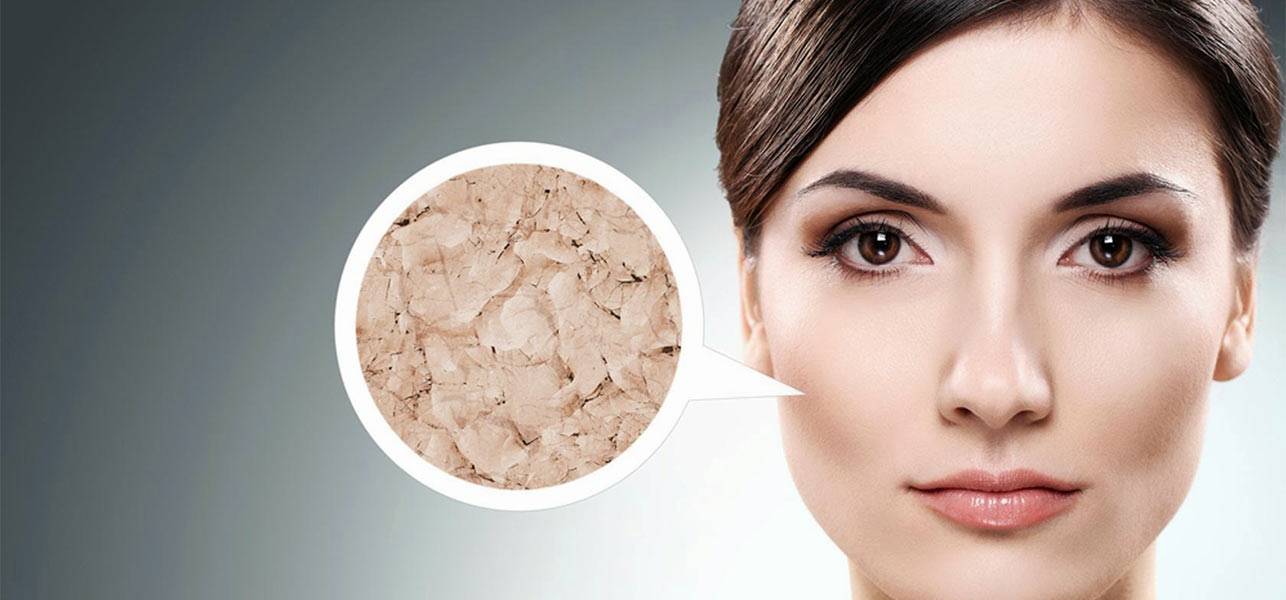 بیماری پوستی ایکتیوز چیست؟ + علائم بیماری