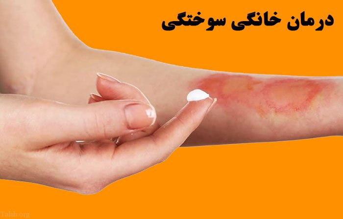 سریع ترین روش های درمان خانگی برای سوختگی های معمولی
