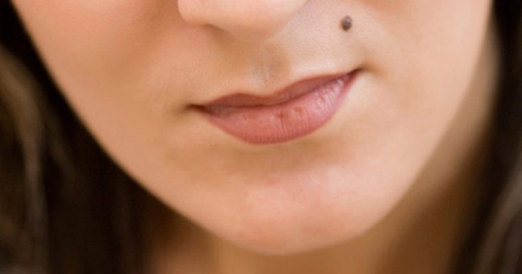 خال‌ها سیاه و قهوه ای روی صورت چه چیزی را نشان می دهد؟ 