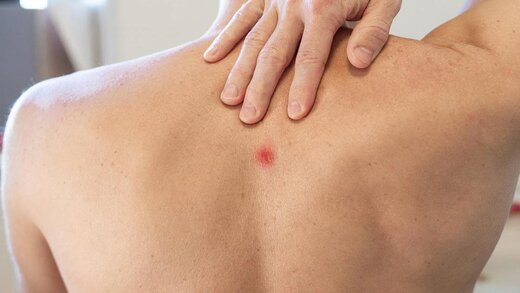 جوش های کمر و حقیقتی عجیب از سلامت شما که فاش می کنند