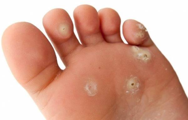 دستورالعمل درمان سریع میخچه