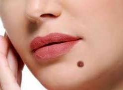 چگونه خال سرطانی را از خال طببیعی تشخیص دهیم؟