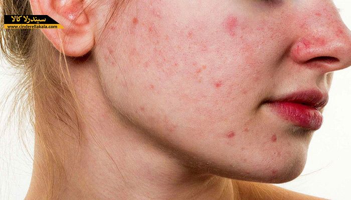 صابون گیاهی سیندرلا، بهترین درمان جوش و لک های پوستی