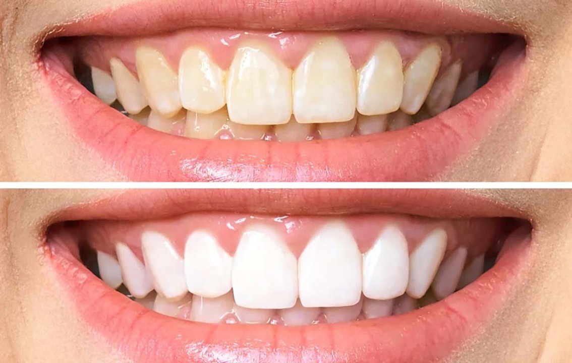 بلیچینگ بهتره یا کامپوزیت؟ مقایسه کامل مزایا، معایب و هزینه هر روش
