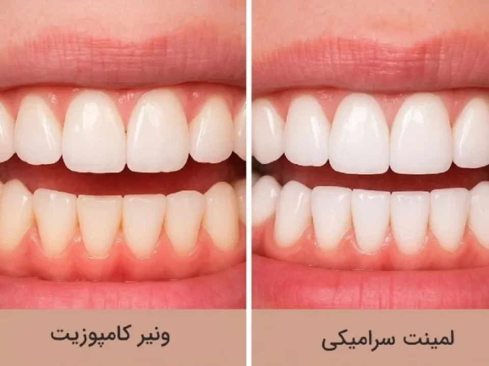 لمینت سرامیکی بهتر است یا کامپوزیت؟ | مقایسه کامل مزایا، معایب و هزینه‌ها