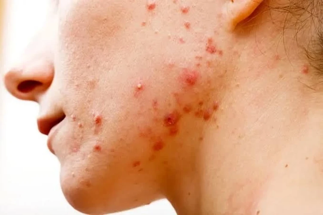 آیا جوش‌های صورت نشانه مشکلات هورمونی هستند؟ | چه زمانی آکنه به اختلالات هورمونی مربوط می‌شود؟