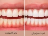 لمینت سرامیکی بهتر است یا کامپوزیت؟ | مقایسه کامل مزایا، معایب و هزینه‌ها