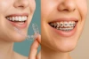 قبل از لمینت و ارتودنسی چه نکاتی باید رعایت شود؟ | راهنمای کامل برای داشتن لبخندی زیبا و ماندگار