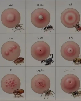 چه حشره‌ای من را گزیده است؟ تشخیص از روی جای نیش