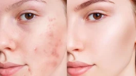 چرا جوش‌های صورت مدام برمی‌گردند؟ این عادت روزانه را جدی بگیرید
