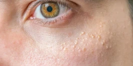 جوش‌های دردناک زیرپوستی را فشار ندهید؛ این عارضه در کمین شماست
