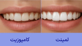 لمینت یا کامپوزیت؛ کدام انتخاب ماندگارتر و مقرون‌به‌صرفه‌تر است؟